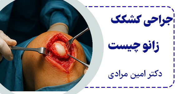 جراحی کشکک زانو چیست